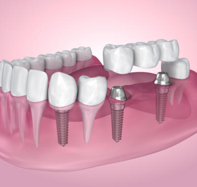 Bridges - Cygnet House Dental