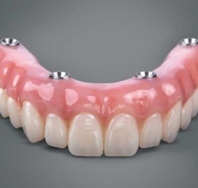 All On 4, All On 6 & Same Day Teeth - Cygnet House Dental