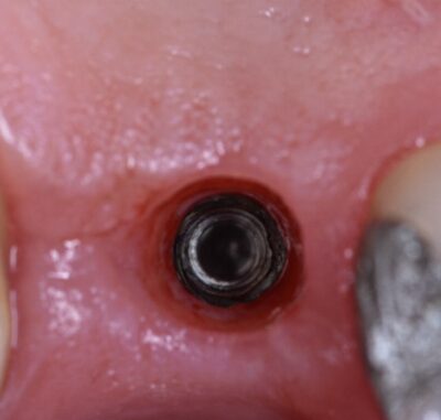 Dental Implants - Cygnet House Dental