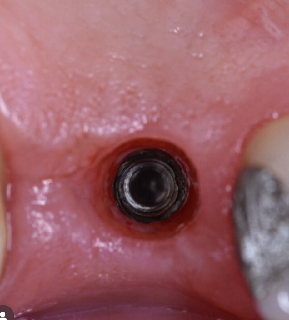 Understanding Dental Implants, Bone Health, And The Role Of Blood Tests