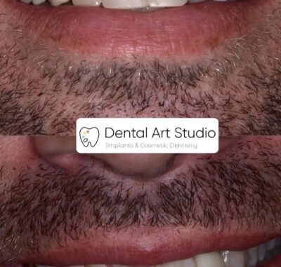 Missing Teeth - Cygnet House Dental