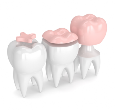 Inlay & Onlay - Cygnet House Dental