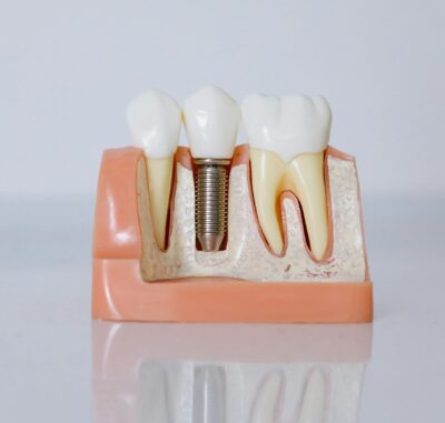 Single Tooth Dental Implant - Cygnet House Dental