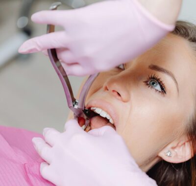 Tooth Extraction - Cygnet House Dental