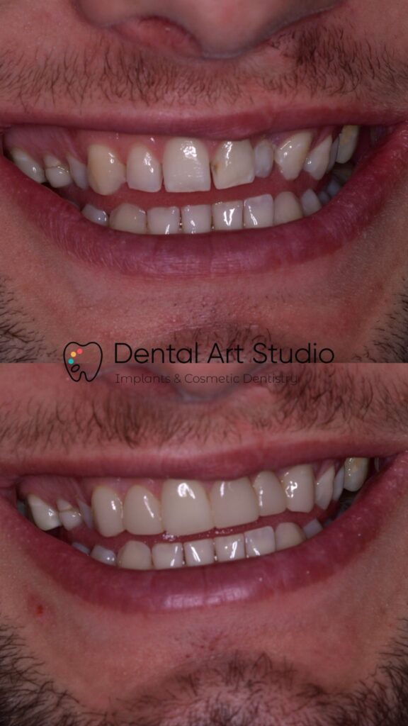 Composite Bonding Lincolnshire | Louth, Skegness, Mablethorpe Smile Makeover
