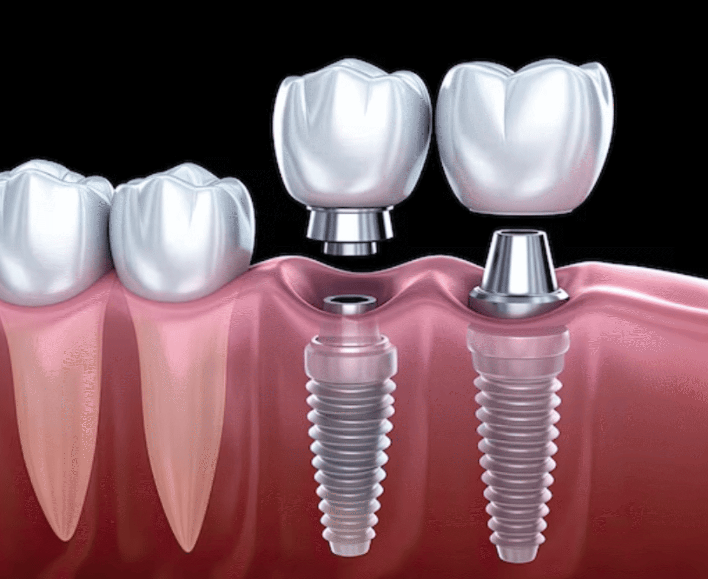 Implant Dentistry